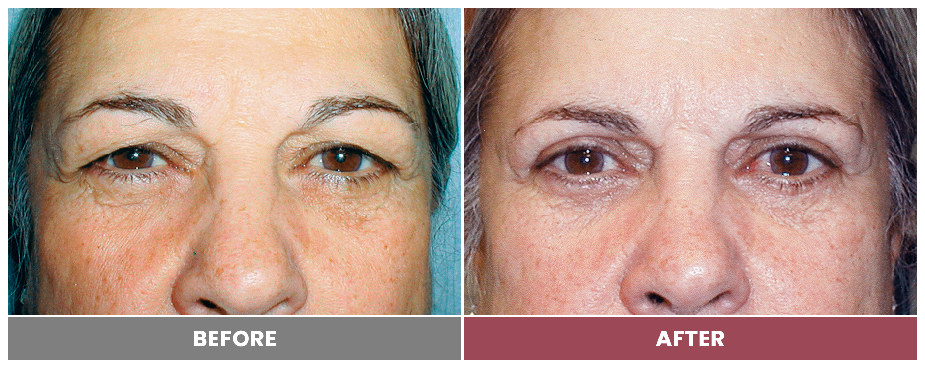 Upper Blepharoplasty - Case 4
